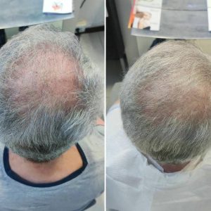 Prima e dopo | Trattamenti da HeadSpa