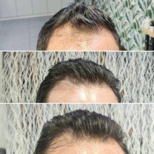 Prima e dopo | Trattamenti da HeadSpa